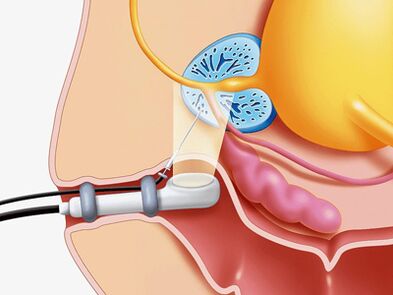 Proboj biopsija prostate