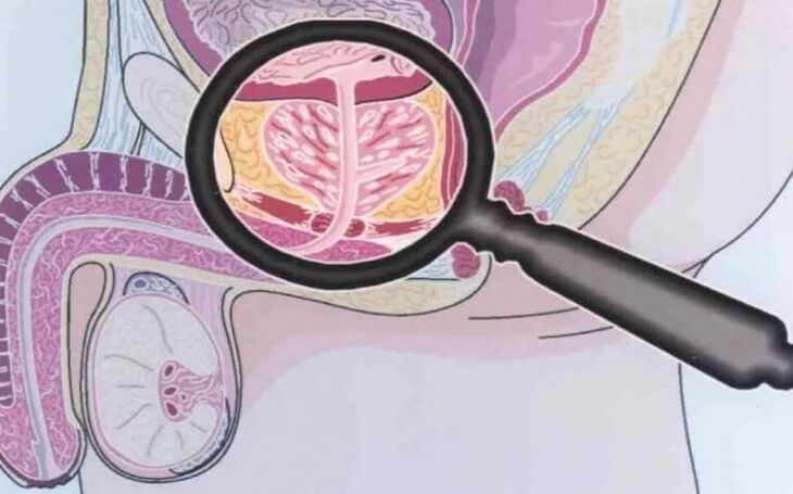 Kronični prostatitis