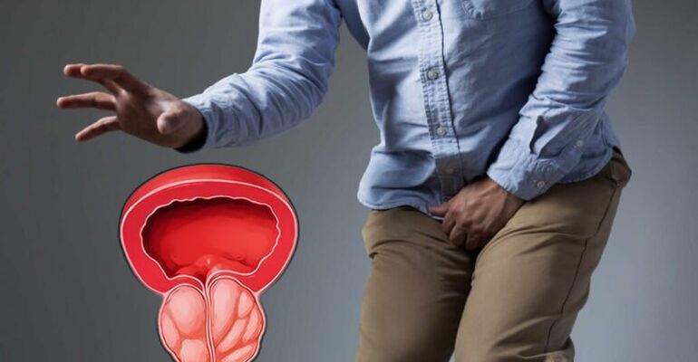 Prevencija prostatitisa i adenoma prostate