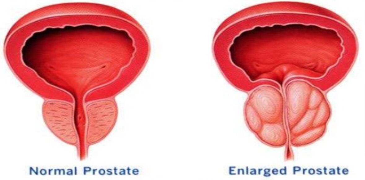 Normalna prostata, upaljena prostata